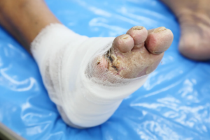 Orthopedic Treatment for Non-Healing Wounds