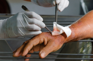 Professional wound debridement in the Philippines