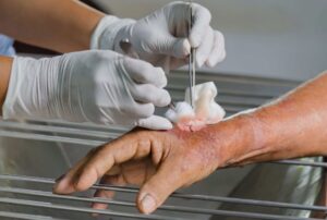 Wound Debridement Services Essential Care for Faster Healing and Infection Prevention