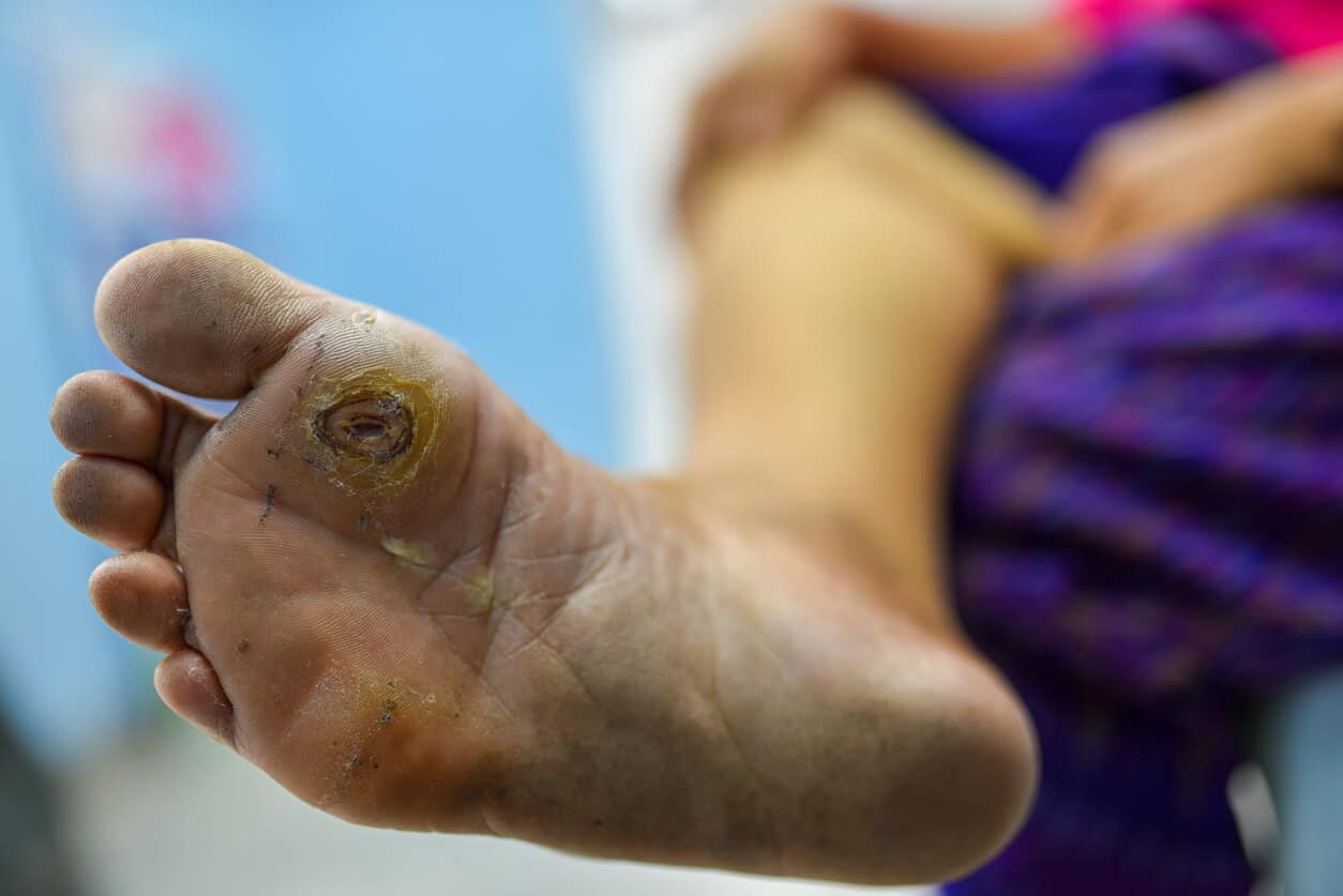 Orthopedic Treatment for Diabetic Gangrene Comprehensive Care for Healing and Prevention