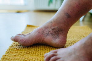 Mastering Comprehensive Diabetic Foot Ulcer Management for Better Health Outcomes