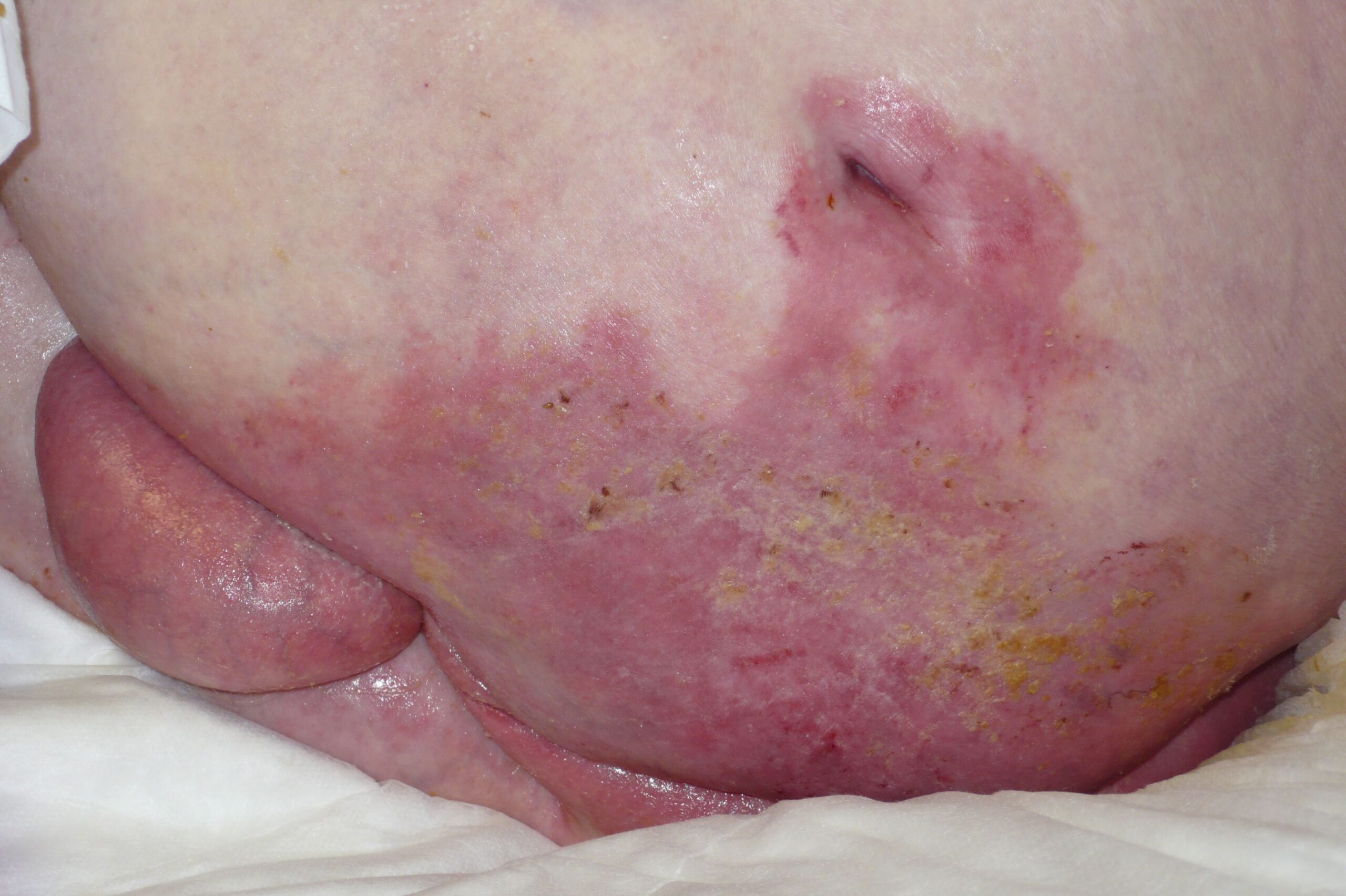 Decubitus Ulcer Treatment Effective Approaches to Healing and Prevention