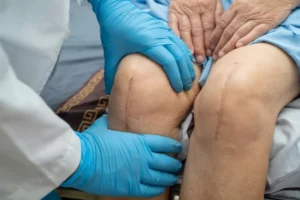 Total Knee Replacement What to Know Before, During, and After Surgery